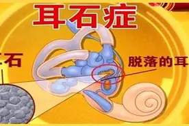 【健康科普】耳石症图片