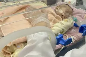 女婴“安安”跨省来济南救治，目前等待手术，做细菌培养图片