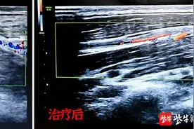 17岁少年血栓了！原因：饮料、熬夜图片