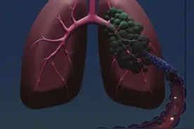 研究发现通过检测分子残留病灶可预测肺癌潜在治愈人群图片