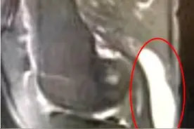膝盖后面长鸡蛋大小包块？可能是腘窝囊肿图片