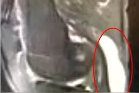 膝盖后面长鸡蛋大小包块？可能是腘窝囊肿图片
