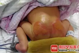7天大婴儿住院时被烫伤，家属索赔80多万元！院方：超过两万免谈图片