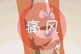 【康复园地】痛风患者的居家康复锻炼图片