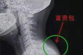 这富贵脂肪不要也罢，4个动作掰正前倾的脖颈图片