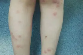 办公区40多盆绿植引来蚊虫，长沙一女子被咬后全身长满红疹和水疱图片