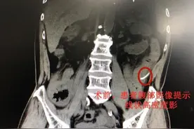 近七旬老人吃鱼头不慎吸入鱼刺，竟刺穿肠道图片