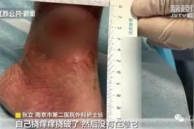 女子挠破蚊子包，脚踝竟烂出一个大窟窿！这类人群要警惕图片