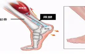 运动达人警惕“后跟之痛”图片