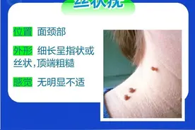 注意！这些地方长“小疙瘩”，可能诱发癌变图片