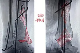 湘雅三医院团队创新方法，帮助患者修复右下肢严重损伤图片