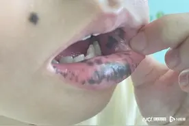 孩子皮肤出现这些黑斑 要当心是消化道发出的警报图片