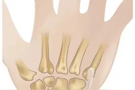 力“腕”狂澜的痛，当心TFCC损伤图片