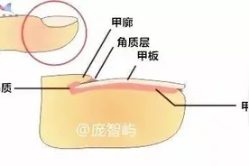 营养不良？疾病预兆？指甲上的竖纹与你的健康有关吗？图片