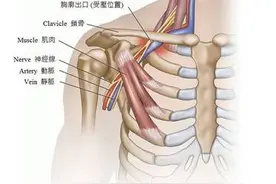 手麻不一定是颈椎病，警惕“胸廓出口综合征”图片