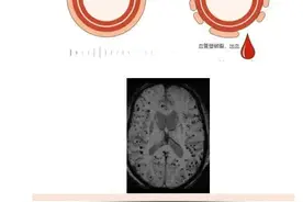 潍坊市人民医院专家为您科普什么是“脑淀粉样血管病”？图片