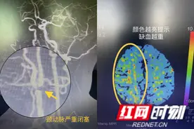 警惕！眼睛黑朦，也可能是脑病图片