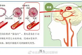 脑梗塞、脑血栓、脑栓塞的区别图片