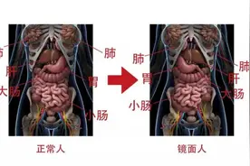 南宁一女子五脏六腑全部反着长，医生：罕见的先天性畸形，发病率约为百万分之一图片