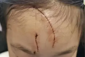 极目锐评｜5岁女童遭狗咬毁容，无论狗主人是谁，千万别只处理狗图片