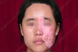 白癜风康复故事：山东“励志妹”用磨难成就多彩人生图片