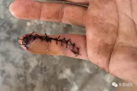徒手救人，他的右手小指被缝13针……图片