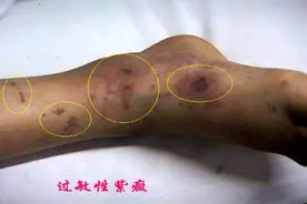【健康科普】小儿过敏性紫癜图片