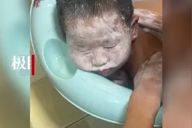 男童为模仿奥特曼在脸上涂满结构胶，家长：用洗衣粉洗了两个小时图片