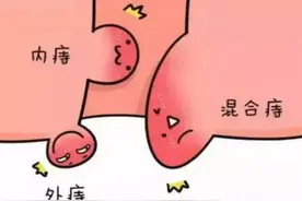 【健康科普】混合痔有哪些症状和危害图片