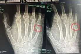 杭州爸爸辅导作业一通怒吼，一拳把自己打骨折……住院时一句话让人心疼图片