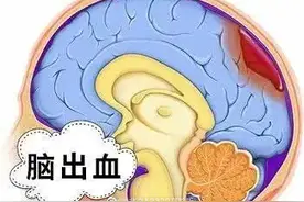 脑出血”发生前会有哪些异常？图片