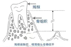老年人的残根牙可以不拔吗？图片
