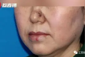 女子鼻头长疙瘩，一直以为是黑头！医生一看：是癌图片