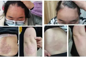 昌乐县人民医院：银屑病不可怕，规范诊疗是关键图片