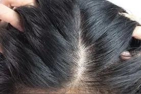 很多人喜欢抠头皮上的小颗粒，到底是什么东西啊？图片