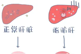得了脂肪肝不要怕！学会这几招，把脂肪“甩”出肝脏图片