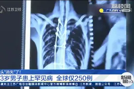 1米8变成1米7，年轻小伙骨头突然“消失”！一查竟是全球罕见的疾病图片
