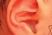为什么我家宝宝的耳朵这么丑？专家：耳廓形态畸形，治疗不要错过“黄金时间”图片