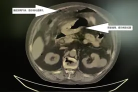 滥用止痛“神药”，男子胃部穿孔多病缠身图片