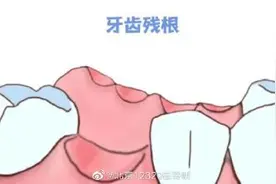 老年人口腔里的牙齿残根可以不拔吗？图片
