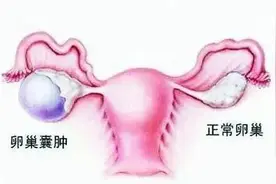 孕前检查发现囊肿，会影响怀孕吗？松江区妇幼保健院医生建议→图片