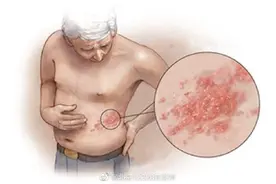 得了带状疱疹有什么表现？图片