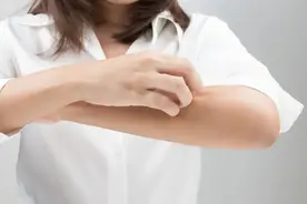 新冠感染后突发荨麻疹怎么办？图片