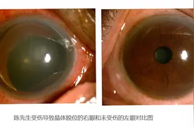 野外露营时眼睛被树枝碎片弹伤，男子险失明图片
