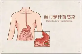怎么知道自己有没有幽门螺杆菌？同时有这3个症状，赶紧去医院检查！图片