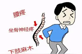 如何判断自己是否患了腰间盘突出？图片