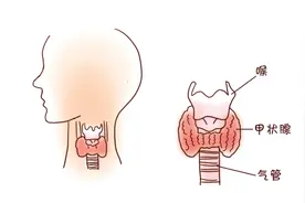 甲状腺疾病到底需要“补碘”还是“限碘”？图片