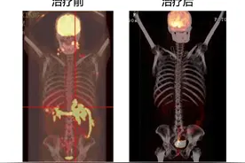 男子淋巴癌扩散全身 深大总医院新型CAR-T细胞治疗实现神奇逆转图片