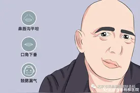 【垂医科普】面瘫病（面神经麻痹）健康处方图片