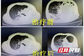 “半个肺”感染病变！湘雅常德医院成功救治一例左侧全肺切除术后新冠感染危重症患者图片